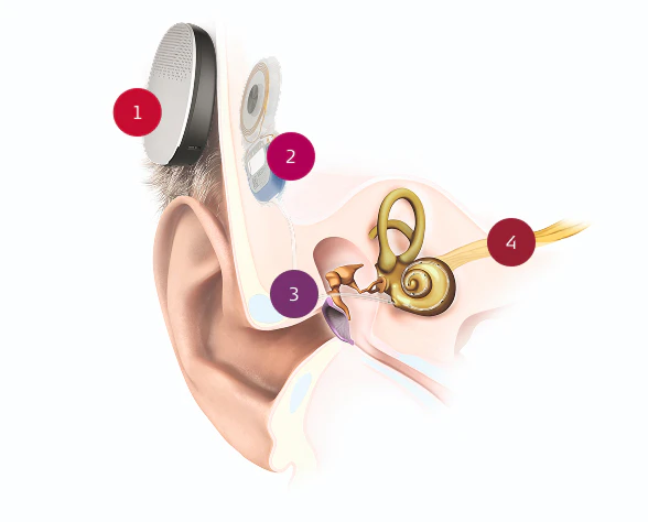 Image of the ear anatomy including the cochlear implant and the external audio processor