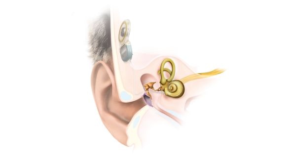 Et pålideligt høreimplantat til hverdagen