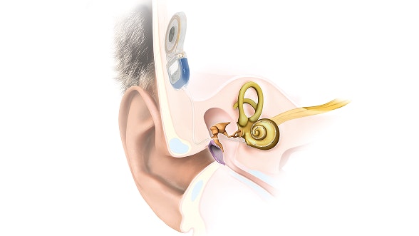 Um implante auditivo confiável para o seu dia a dia Um implante auditivo confiável para o seu dia a dia