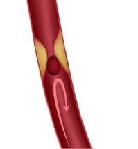 Reduced blood flow (ischaemic stroke, cerebral infarction)