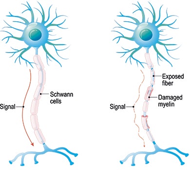 Causes of multiple sclerosis