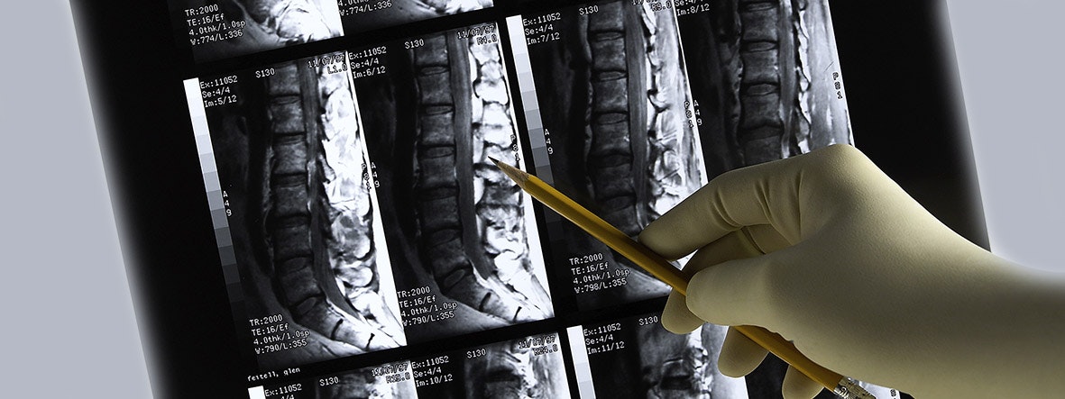 Diagnosis of tetraplegia