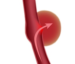 Hirnblutung (hämorrhagischer Schlaganfall)