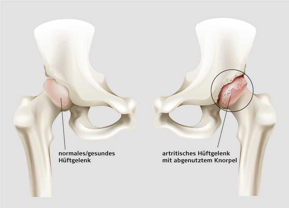 Was ist eine Hüftarthrose?