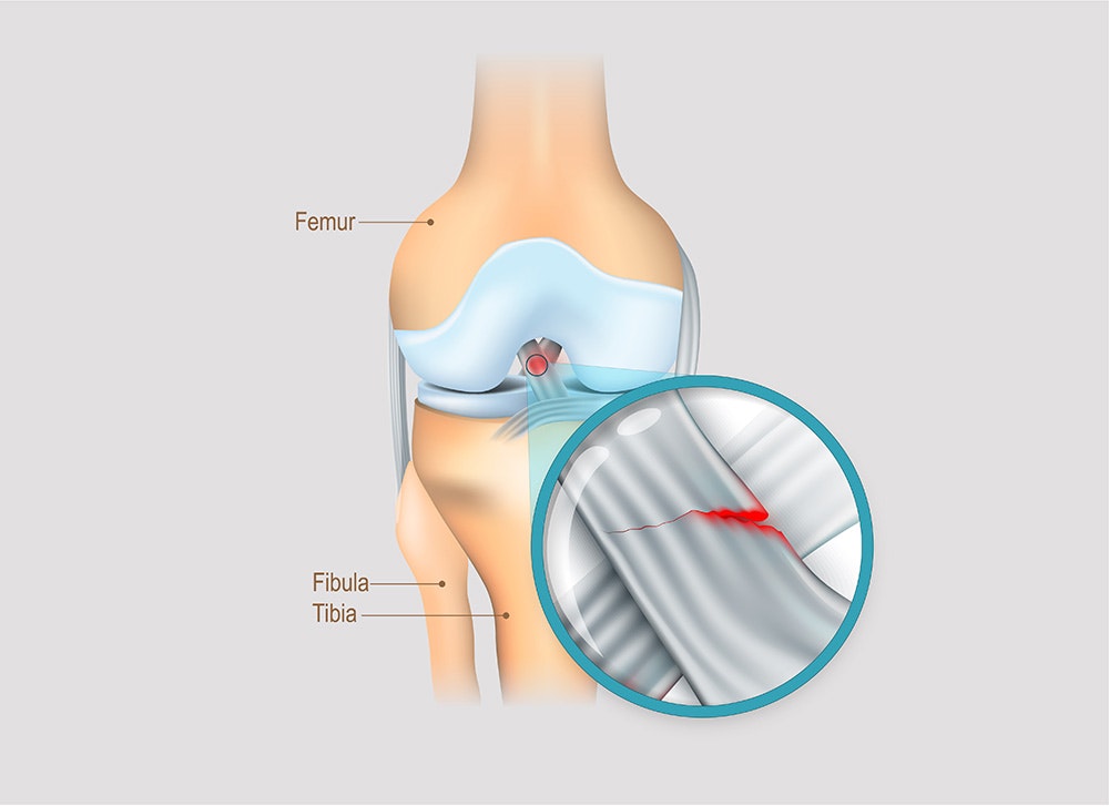 What is a cruciate ligament rupture?