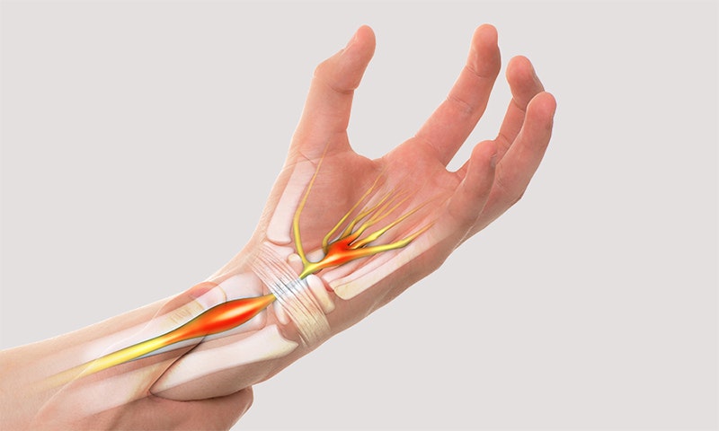 What is carpal tunnel syndrome?